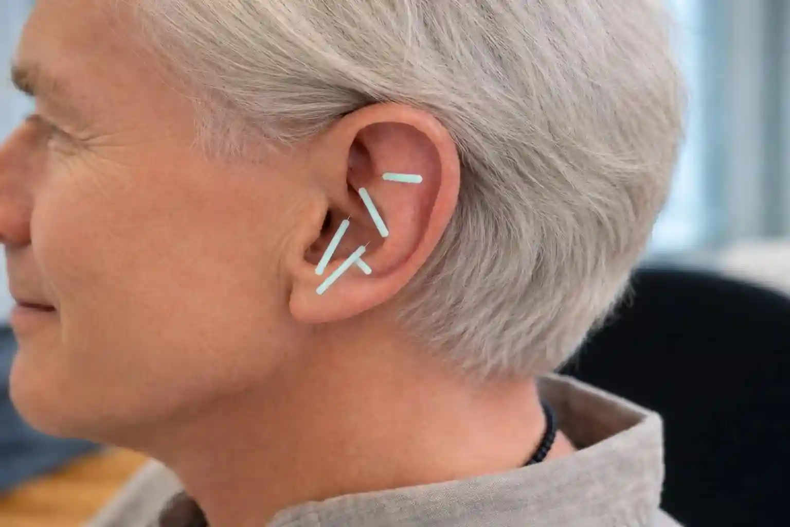 Nahaufnahme eines Ohres eines Mannes, welcher sich mit der NADA-Ohrakupunktur/Presur mittels Nadeln behandeln lässt.